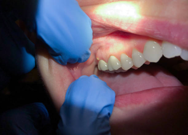 Best Emergency Wisdom Tooth Extraction in Union City, MI